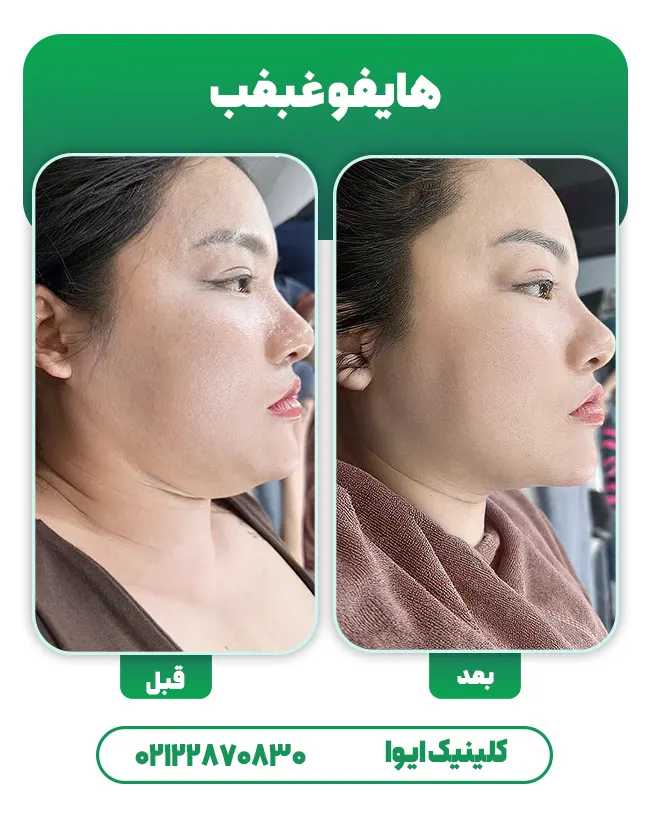 قبل بعد هایفو غبغب