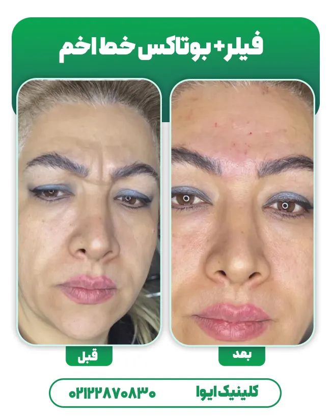 فیلر و بوتاکس خط اخم