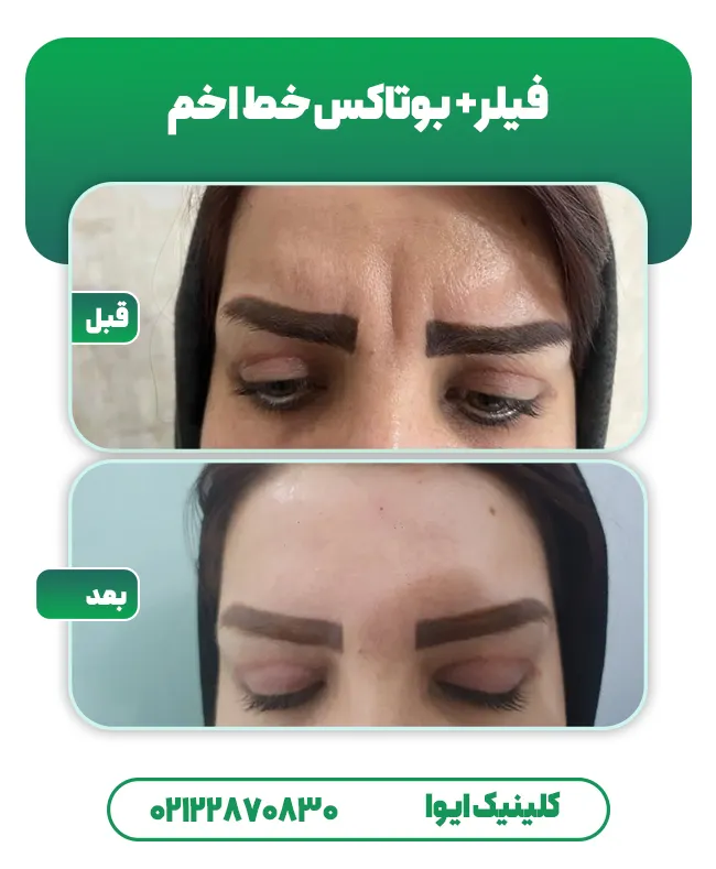 فیلر و بوتاکس خط اخم