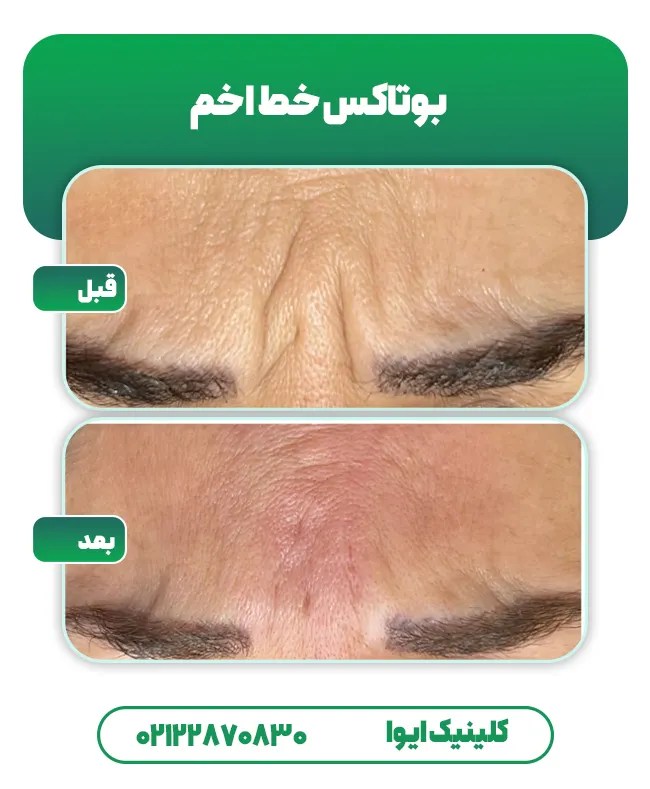 بوتاکس خط اخم