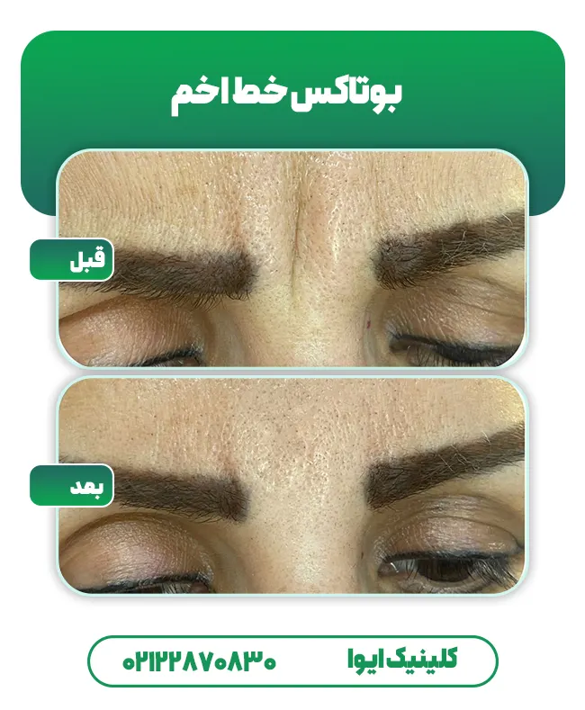 بوتاکس خط اخم