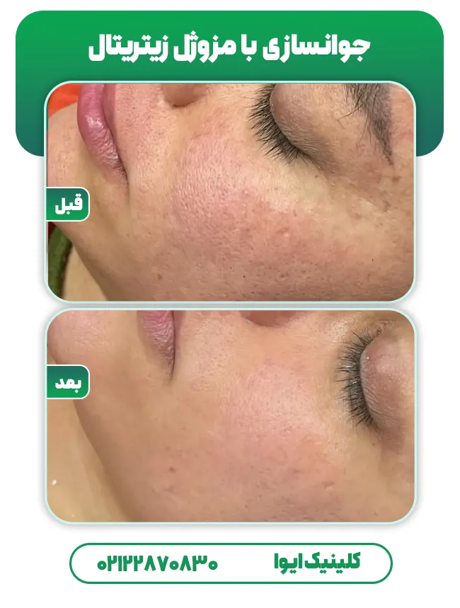 قبل و بعد مزوژل‌ زیتریتال