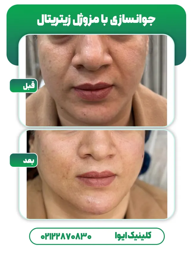 قبل و بعد مزوژل‌ زیتریتال
