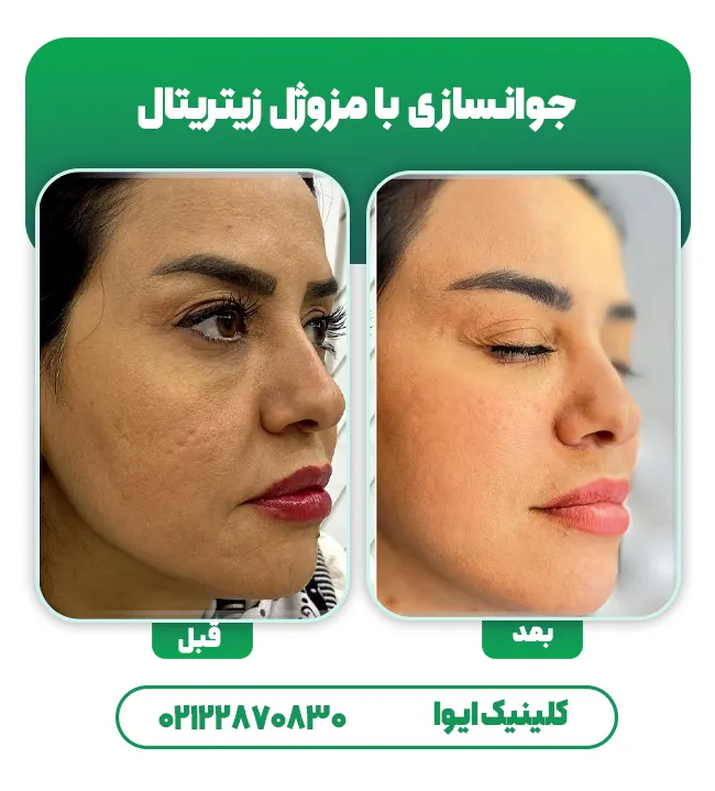 قبل و بعد مزوژل‌ زیتریتال