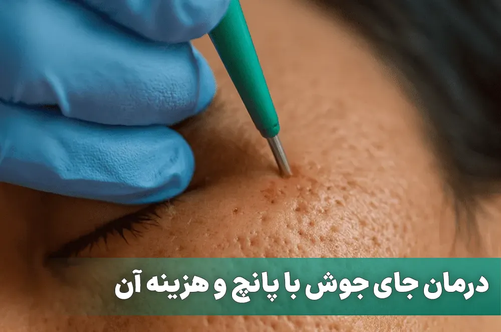 پانچ جای جوش برای درمان اسکار آکنه