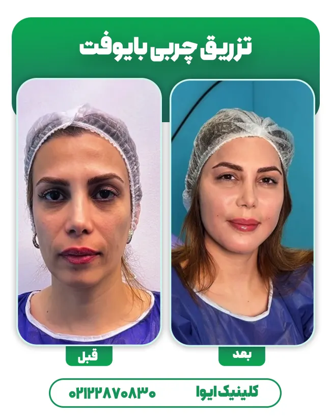 تزریق چربی بایوفت