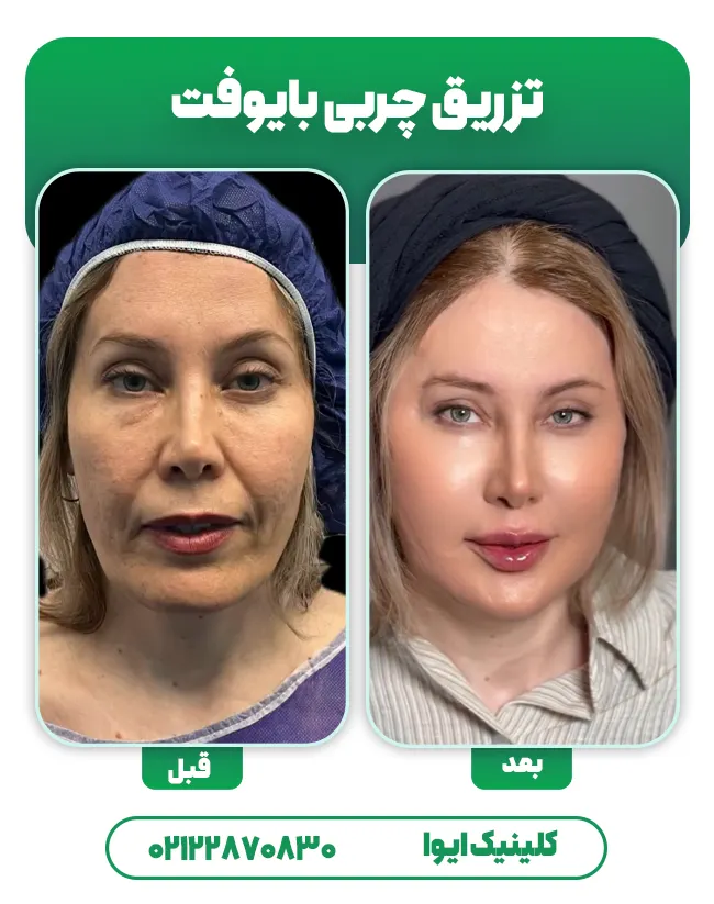 تزریق چربی بایوفت