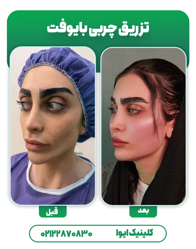 تزریق چربی بایوفت