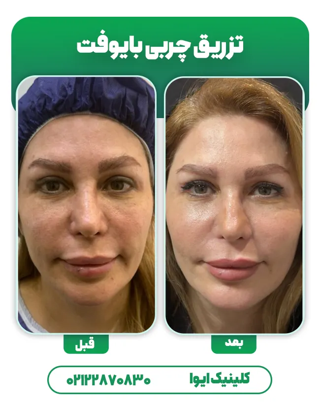 تزریق چربی بایوفت