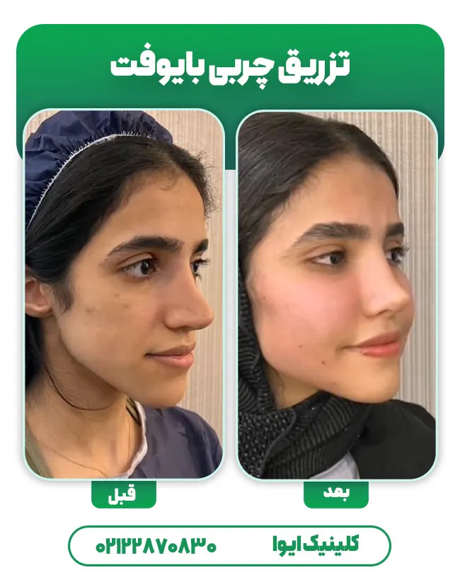 تزریق چربی بایوفت