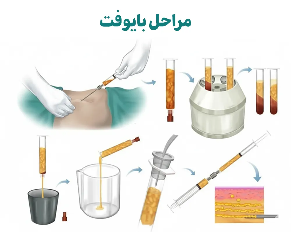 مراحل تزریق چربی بایوفت