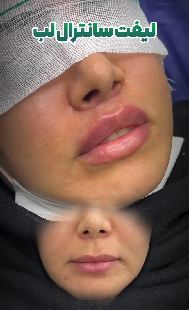 لیفت سانترال لب