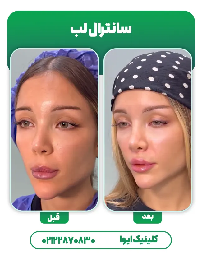 عمل سانترال لب قبل و بعد