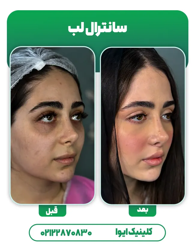 جراحی سانترال لب