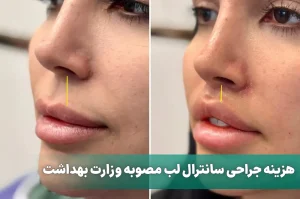 هزینه جراحی سانترال لب مصوبه وزارت بهداشت