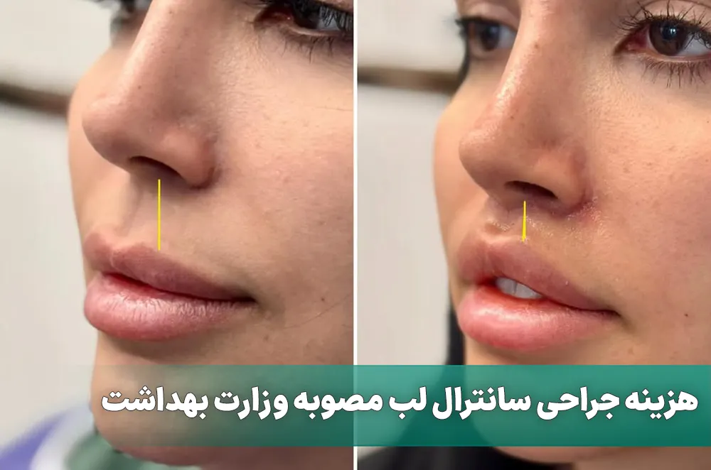 هزینه جراحی سانترال لب مصوبه وزارت بهداشت