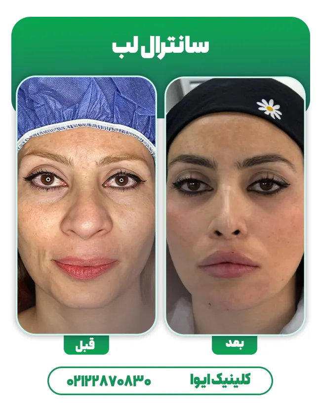 عمل لیفت سانترال لب