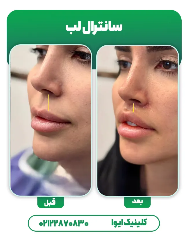 جراحی سانترال لب