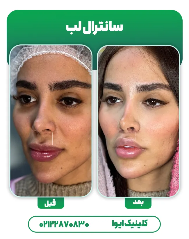 جراحی سانترال لب