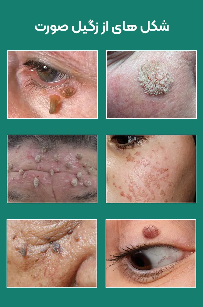 انواع زگیل صورت