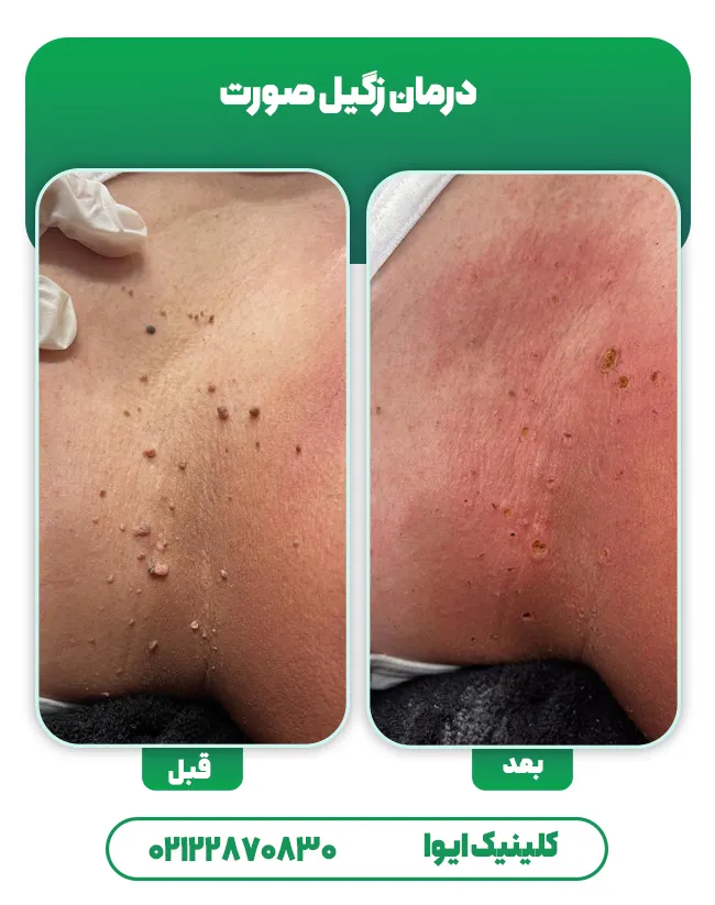 درمان زگیل صورت