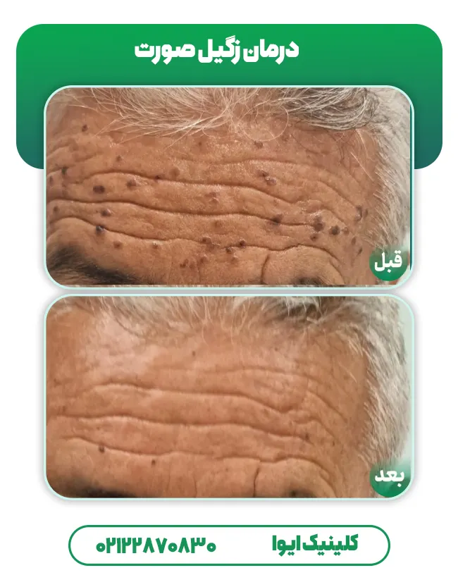 درمان زگیل صورت