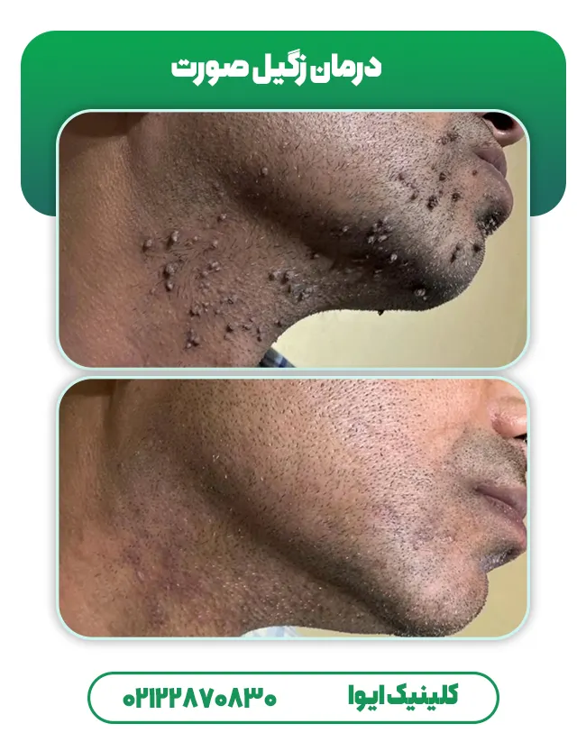قبل بعد درمان زگیل صورت
