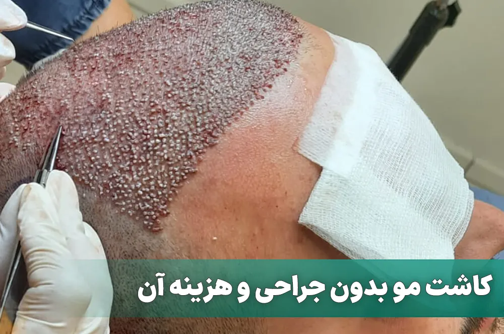 کاشت مو بدون جراحی