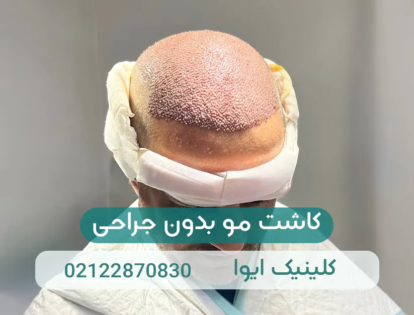 کاشت مو بدون جراحی