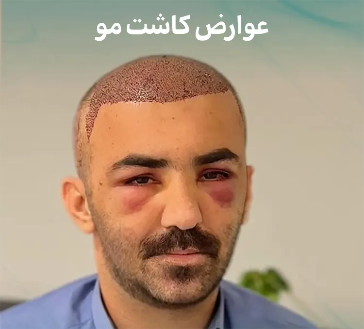 عوارض کاشت مو