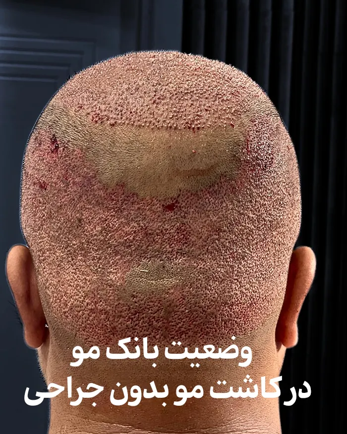 بانک مو در کاشت مو بدون جراحی