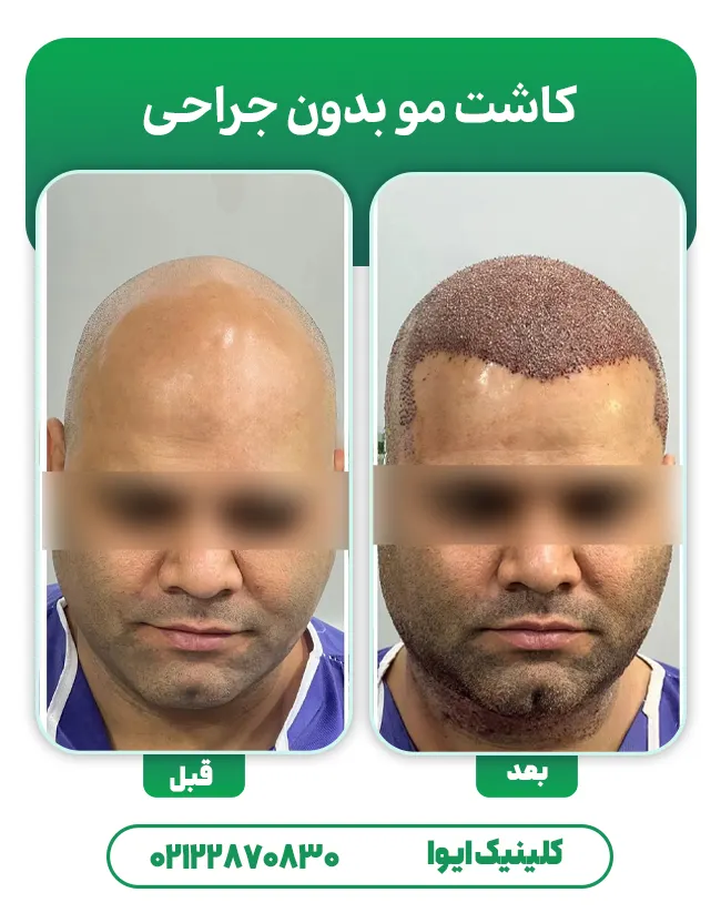 کاشت مو بدون جراحی