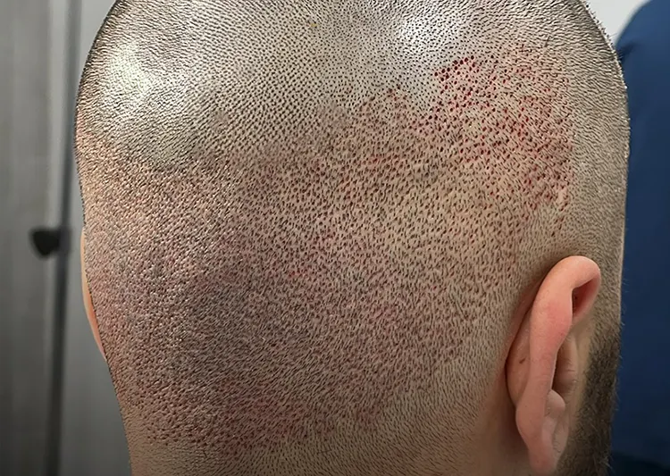 کاشت مو بدون جراحی