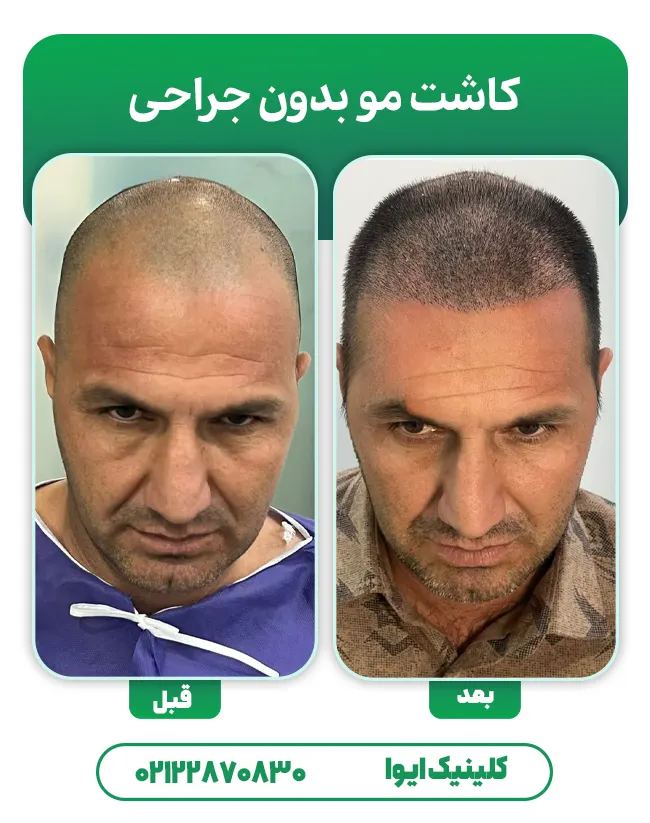 کاشت مو بدون جراحی