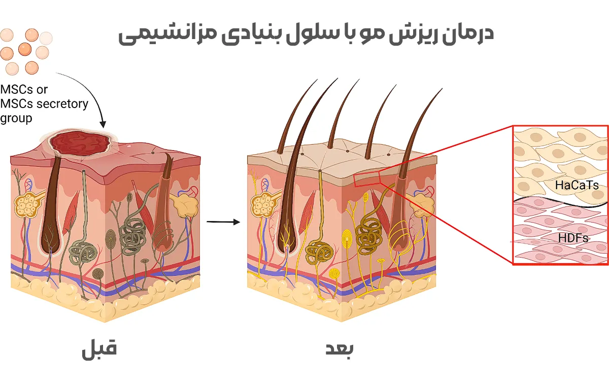 درمان ریزش مو با سلول‌ های بنیادی مزانشیمی