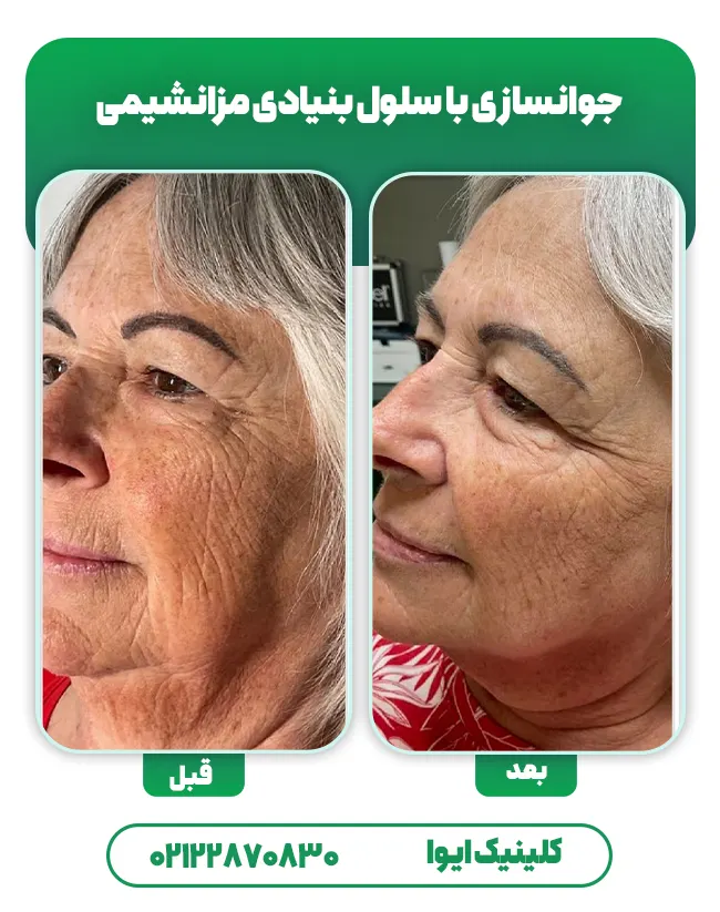 جوانسازی پوست با سلول بنيادی مزانشيمی