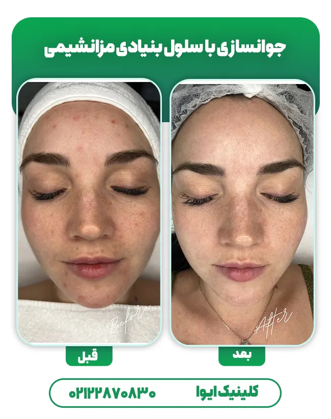 جوانسازی با سلول بنيادی مزانشيمی