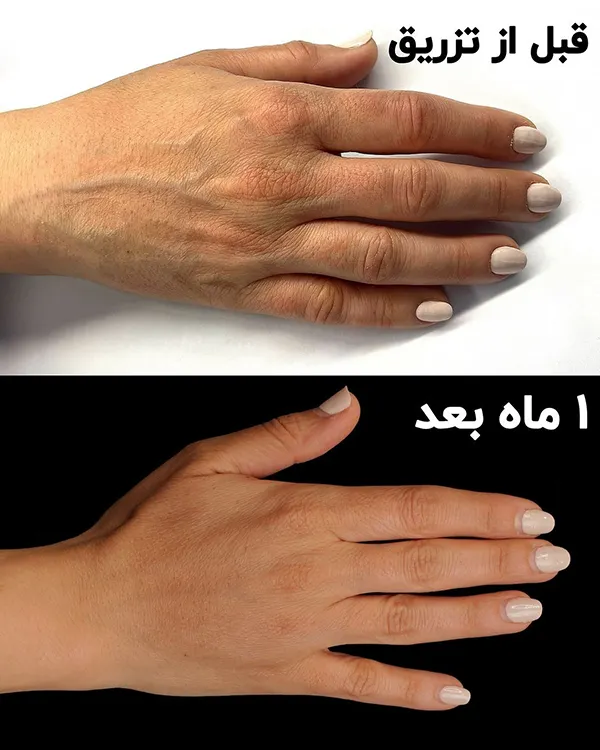 تزریق چربی دست به روش نانوفت