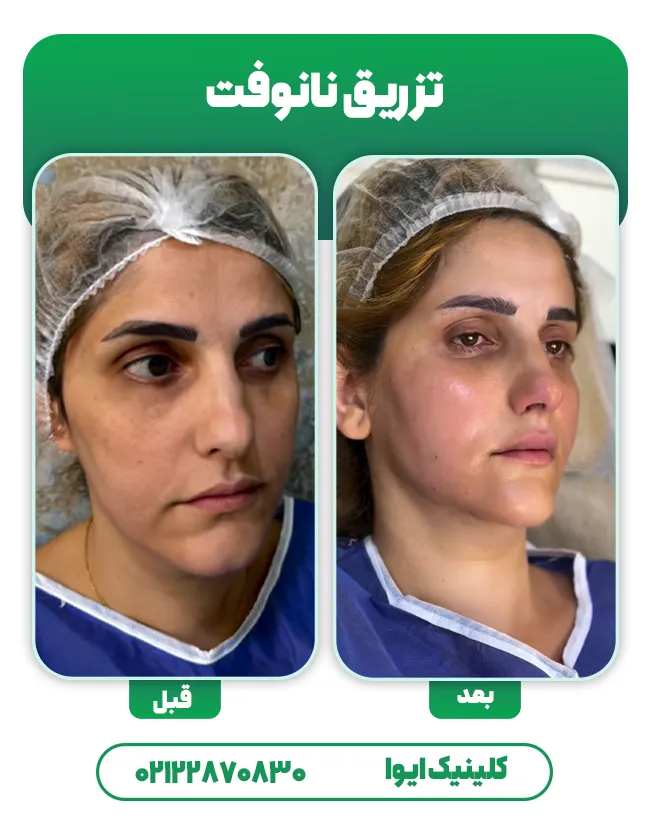 تزریق چربی به روش نانوفت