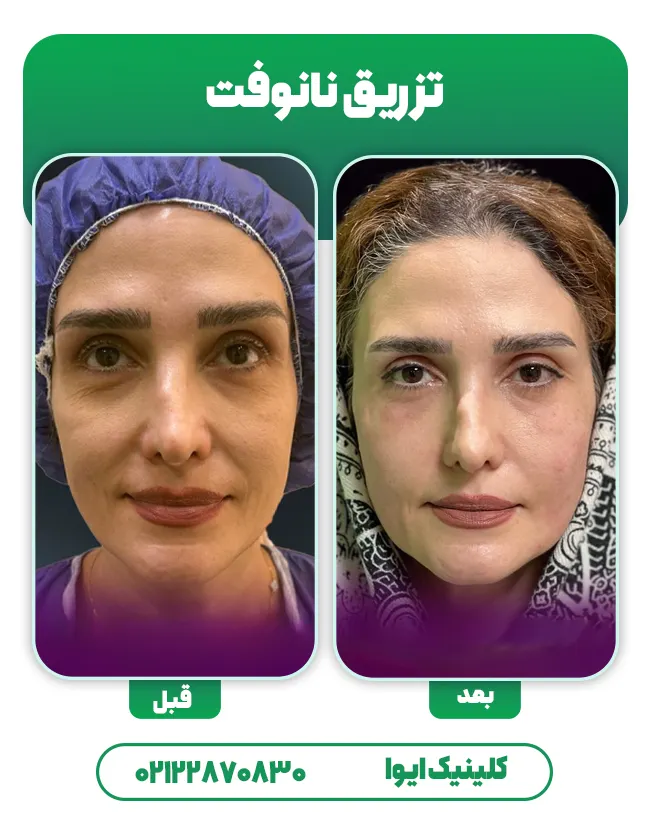 تزریق چربی به روش نانوفت