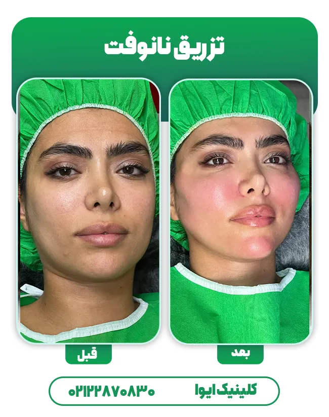 تزریق چربی به روش نانوفت