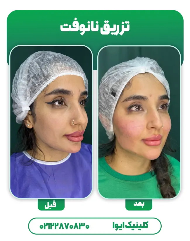 تزریق چربی به روش نانوفت