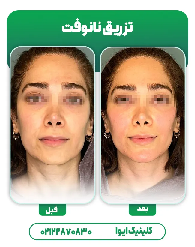 تزریق چربی به روش نانوفت