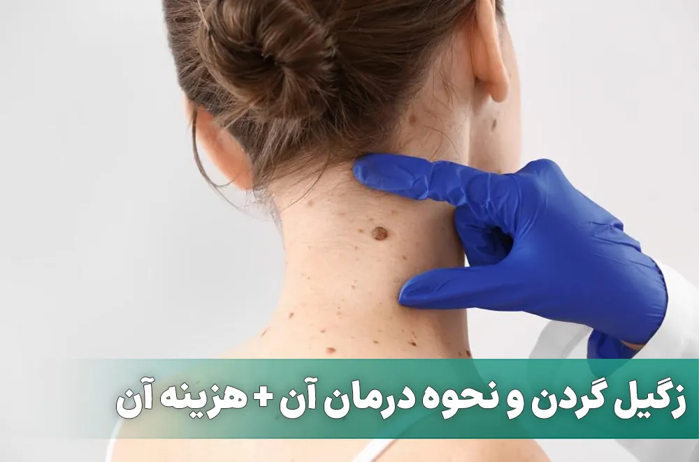 زگیل گردن و نحوه درمان آن