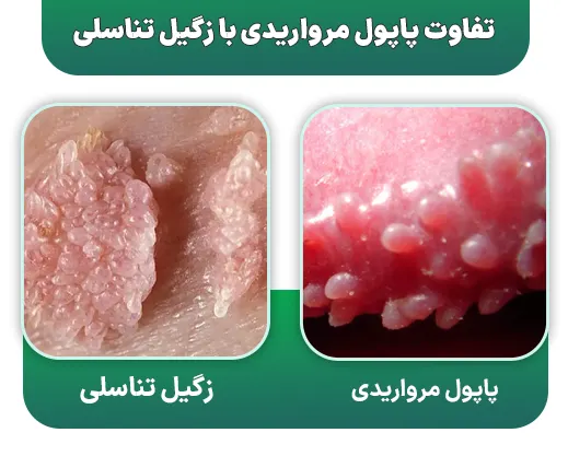 تفاوت پاپول مرواریدی با زگیل تناسلی