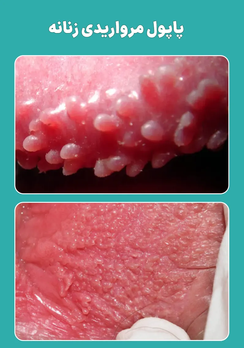 پاپول مرواریدی زنانه