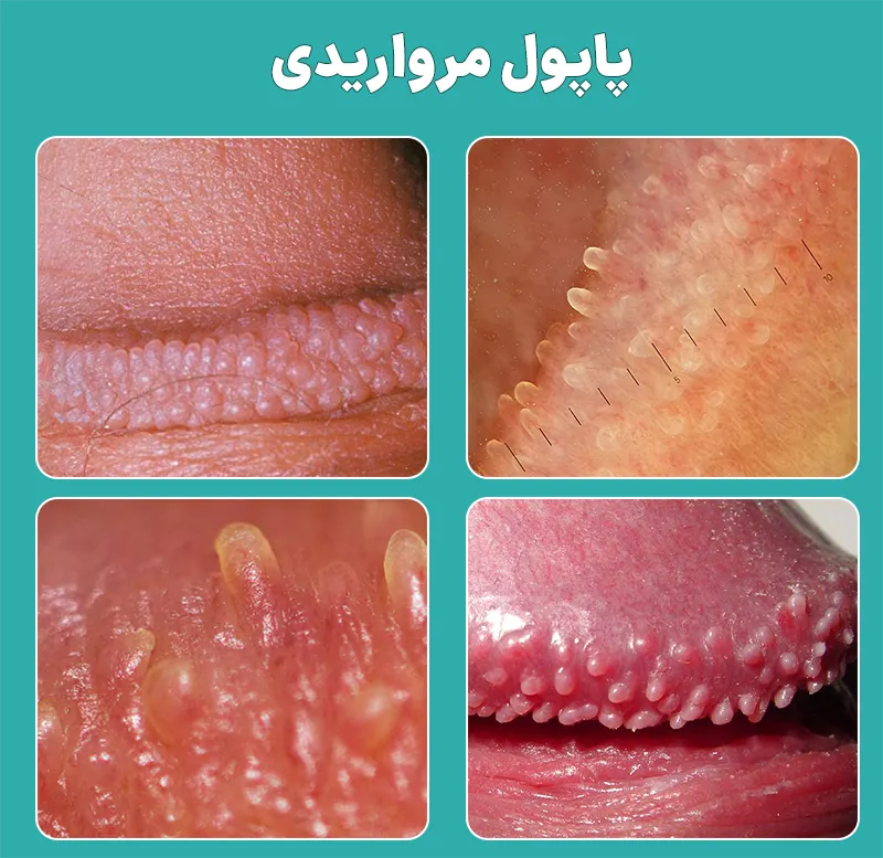 پاپول مرواریدی