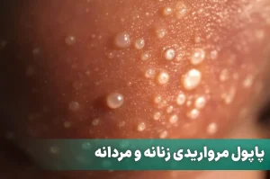 پاپول مرواریدی