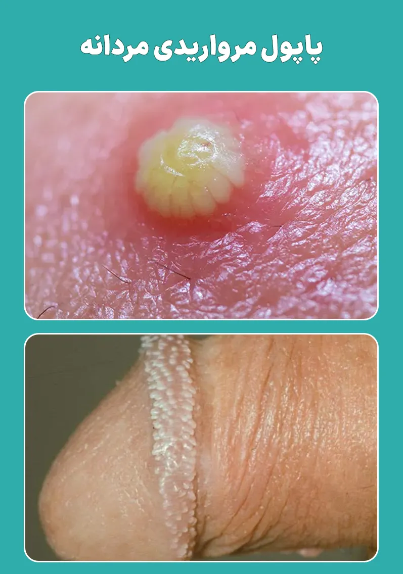 پاپول مرواریدی مردانه