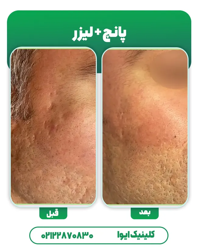 پانچ جای جوش